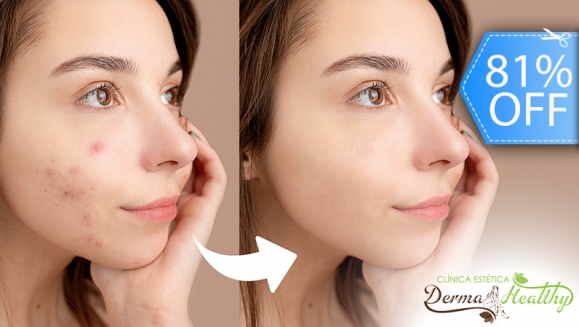 [Image: ¡Paga Q169 en Lugar de Q900 por Terapia Clínica Anti Acné: Luz Pulsada en 2 Puntos del Rostro + Alta Frecuencia + Exfoliación Suave + Extracción de Impurezas + Mascarilla Combinada Descongestiva y Desinfectante + Serum Antimanchas!m]