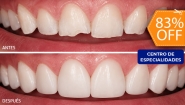 [Image: ¡Paga $40 en Lugar de $230 por Reconstrucción Estética Mínimamente Invasiva con Resina de 4 Dientes Frontales + Consulta General + Revisión de Cordales + Limpieza Dental + Aplicación Tópica de Flúor!m]
